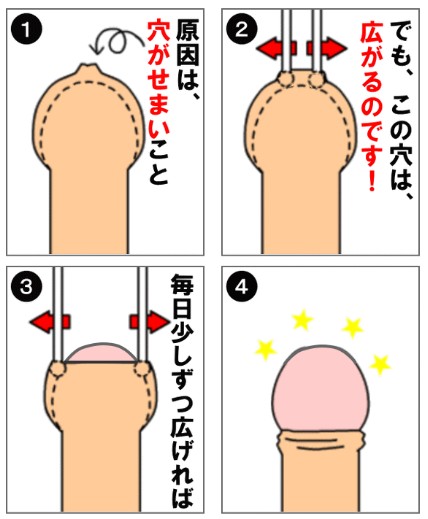 キトー君 真性包茎矯正グッズ販売サイトへ